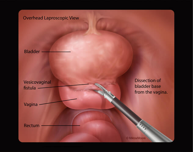 Why is bladder suspension surgery performed?