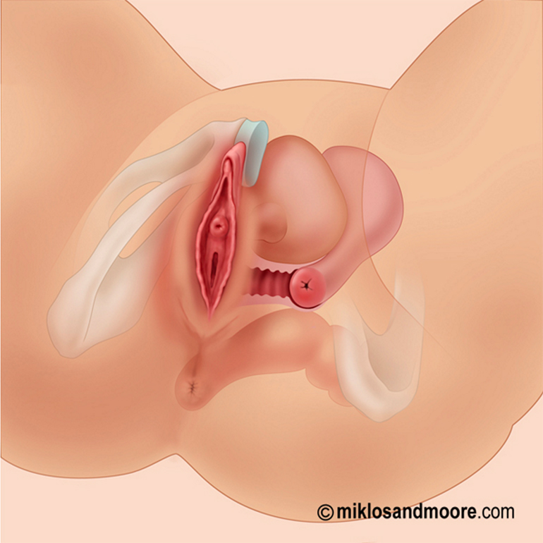 Labiaplasty