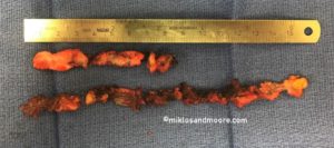 Mesh Removal