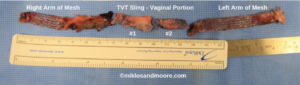 Figure 12: 21 cm of TVT Sling Removed (100% of TVT mesh removed)