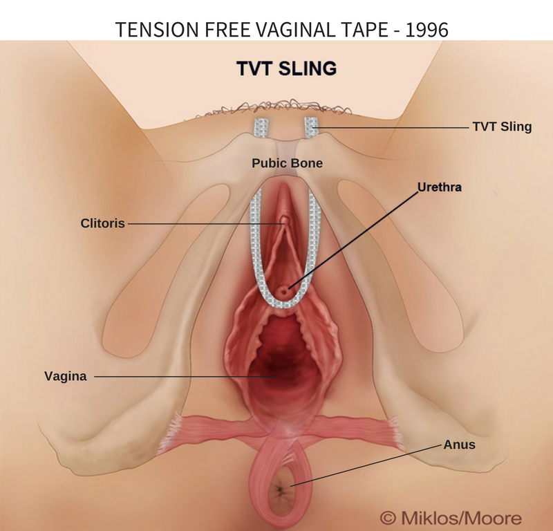 Hysteropexy Atlanta, Vaginal Prolapse