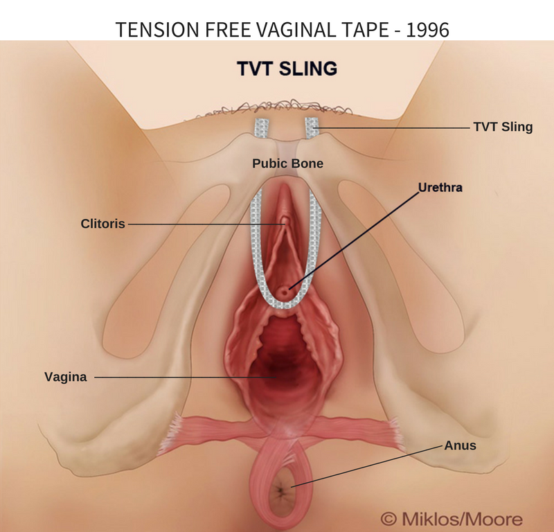 Figure 1: Normal placement of TVT retropubic sling.