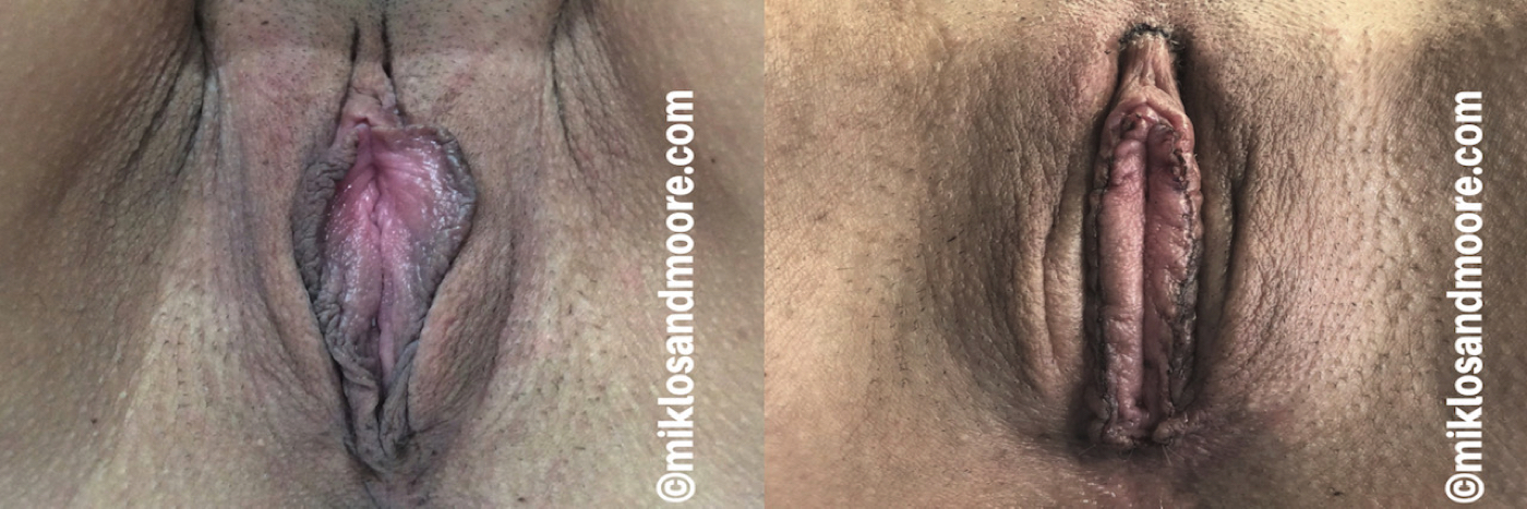 Are not Clit reduction surgery pics mistake Hope, you Clit reduction surgery pics thought differently