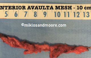 Figure 4 - Anterior Avaulta