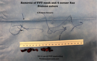 Figure 4: Removal of the remaining 10 cm of TVT Advantage mesh and all 4 Prolene sutures of the 4 Corner Raz procedure, which requires a laparoscopic approach.