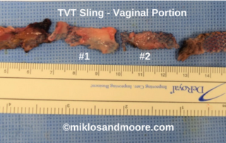Figure 12: 21 cm of TVT Sling Removed (100% of TVT mesh removed)