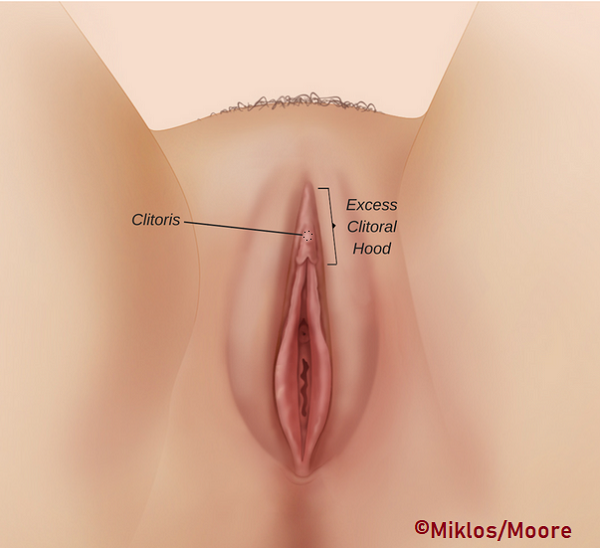 Clitoral-Hoodectomy-Before