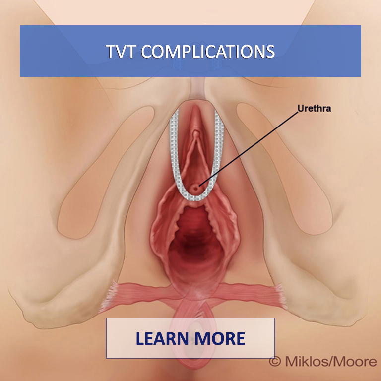 TVT-Complications