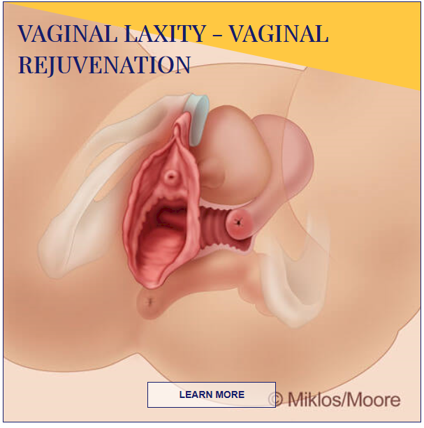 Vaginal laxity - vaginal rejuvenation