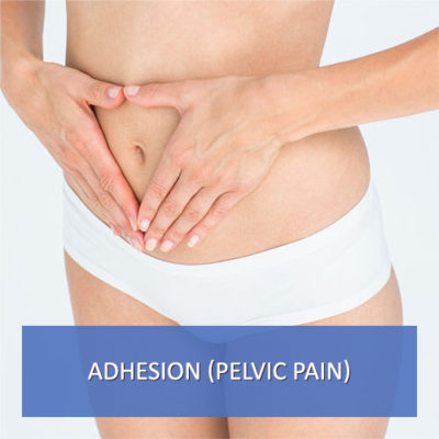 abdominal adhesions