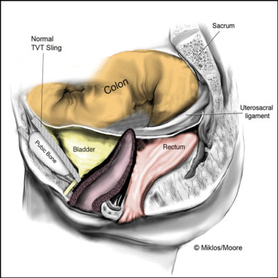 normal tvt sling