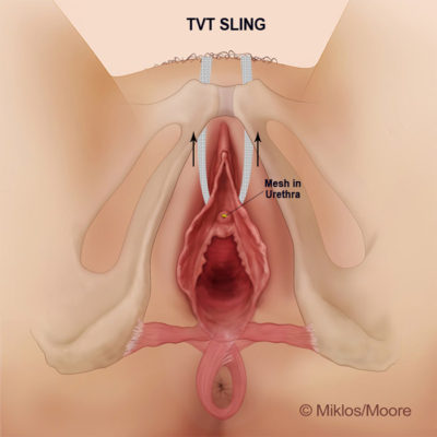 mesh in urethra