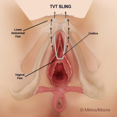 TVT Sling painful sex