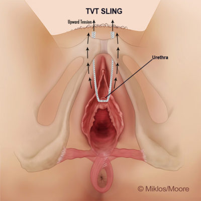 upword tension abdominal pain