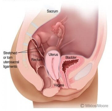 prolapse uterus