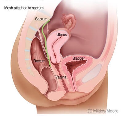 LAPAROSCOPIC HYSTEROPEXY