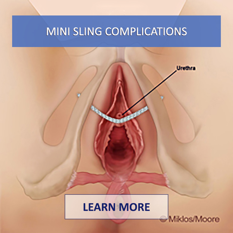 Mini-Sling-Complications