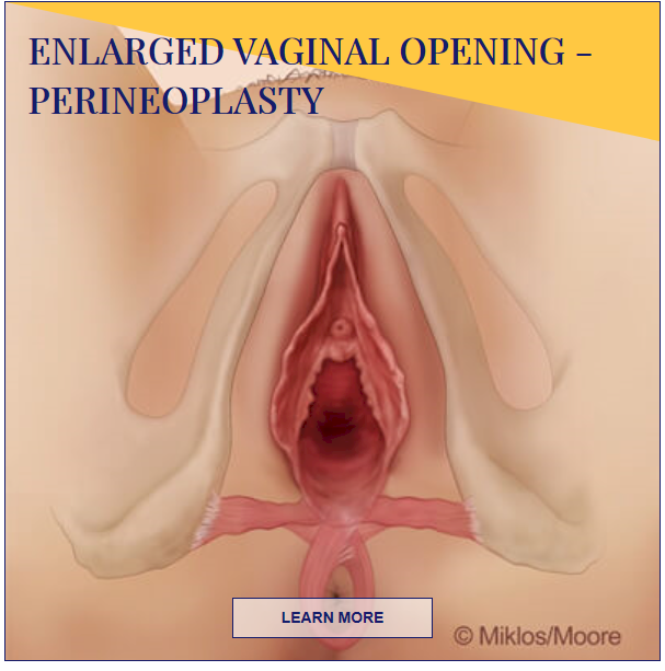 enlarged vaginal opening - perineoplasty