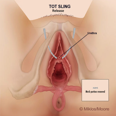 UPWARD TENSION - OBSTRUCTING URETHRA