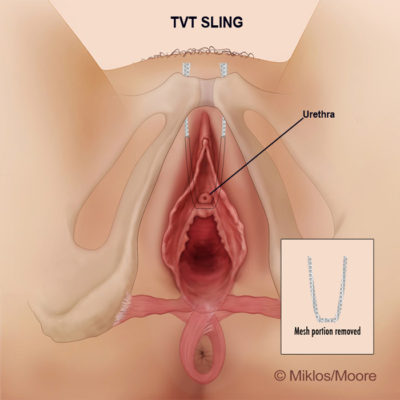 Retrograde Hysterectomy Cut The Anterior Vaginal Wall
