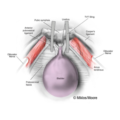 NORMAL TVT SLING (INTERIOR)