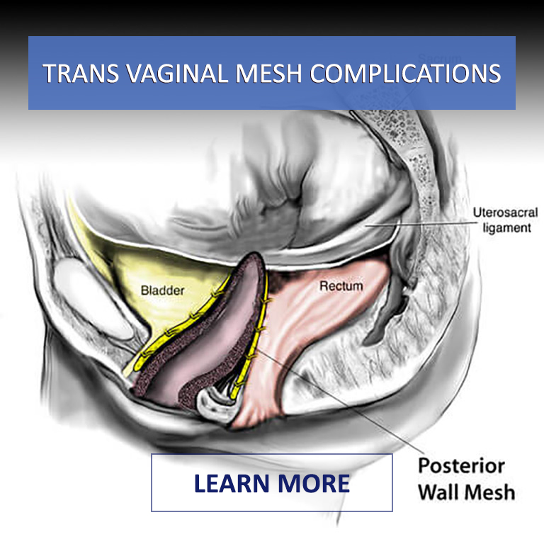 Trans-Vaginal-Complications