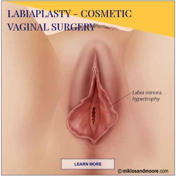 labiaplasty - cosmetic vaginal surgery