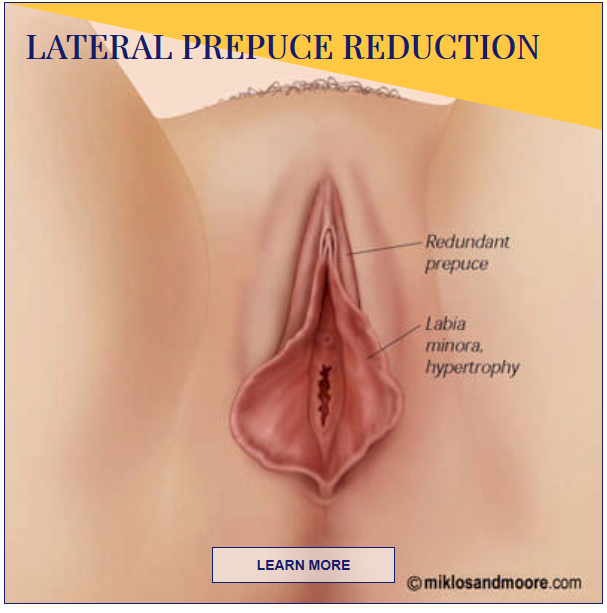 lateral prepuce reduction