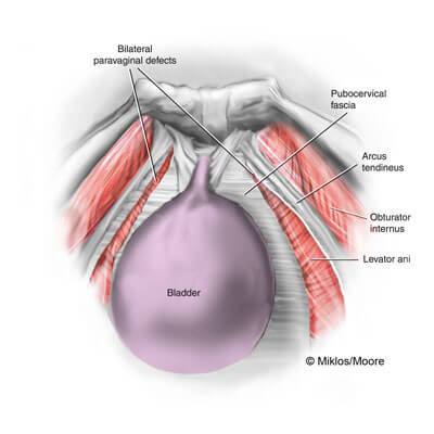 Cystocele – due to paravaginal defects