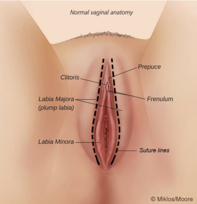 Labia-Majora-Afte