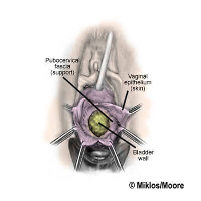 Broken pubocervical fascia is identified