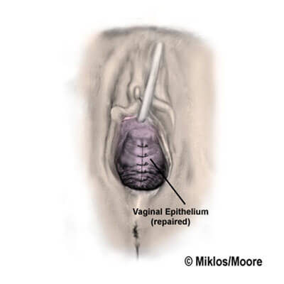 Skin closure under bladder