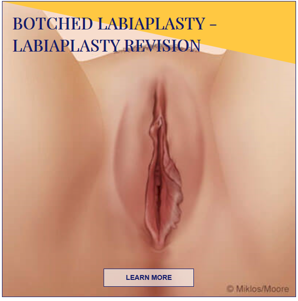 botched labiaplasty