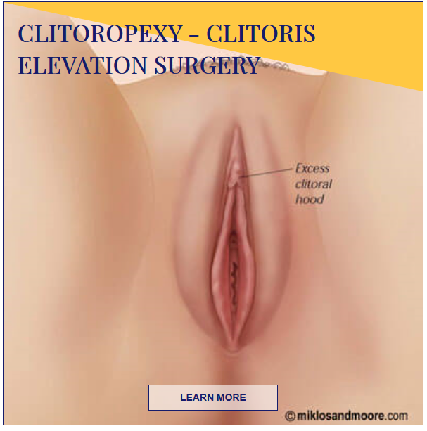 clitoropexy - clitoris elevation surgery