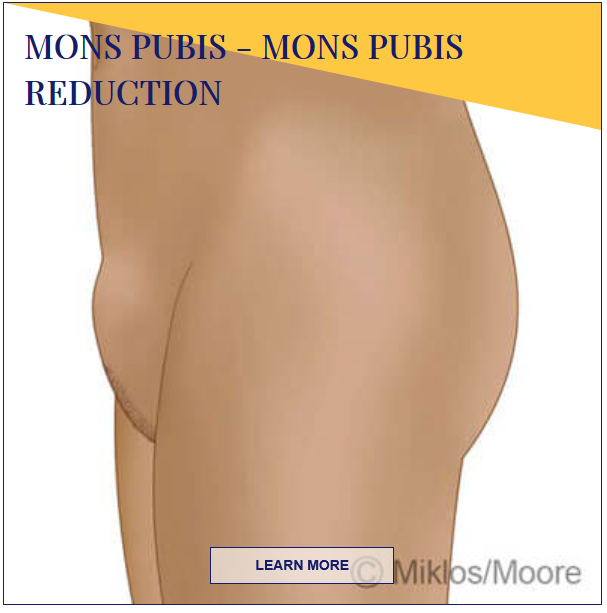 mons pubis - mons pubis reduction