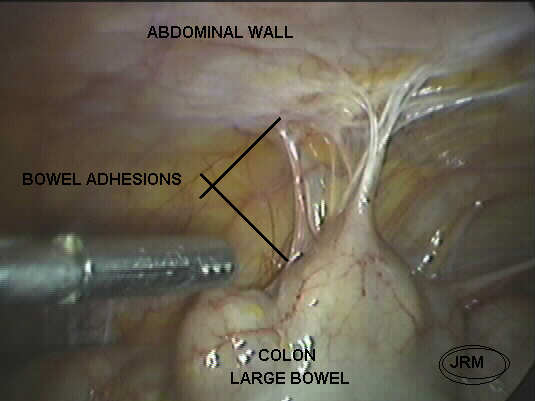 abdominal adhesions 1