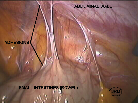 abdominal adhesions 2