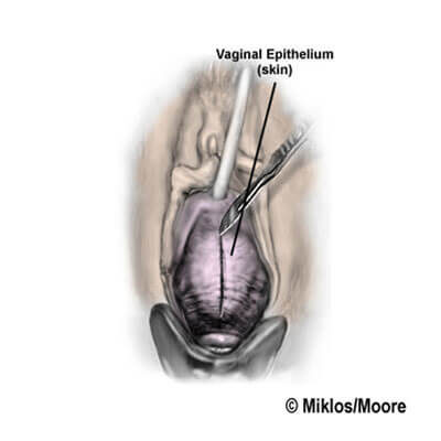 An incision is made in the skin.