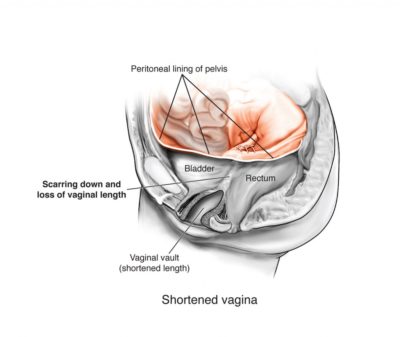 shortened vagina