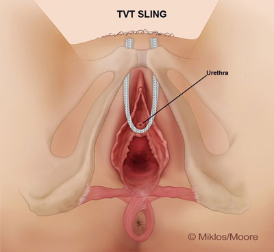 Tension TVT Sling