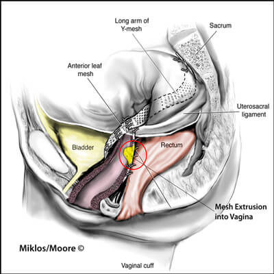 Painful intercourse