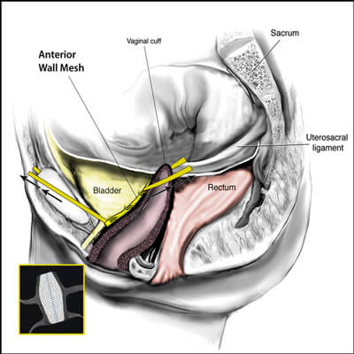 TRANSVAGINAL MESH IMPLANT - POSTERIOR