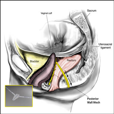 TRANSVAGINAL MESH IMPLANT - ANTERIOR