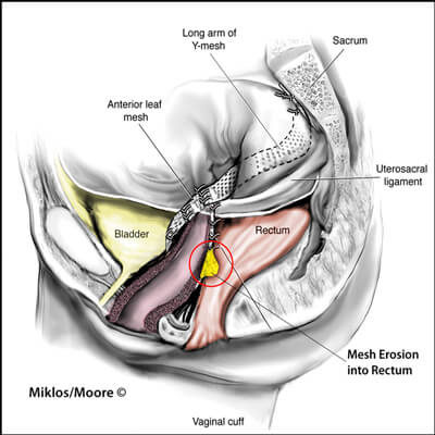 INFECTION/ABSCESS OF MESH