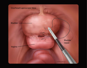 Final bladder closure during laparoscopic vesicovaginal fistula repair