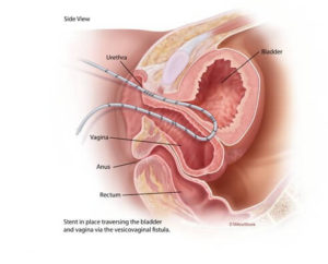 Final stent placement through the vesicovaginal fistula before laparoscopic repair