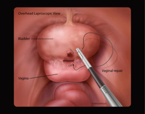 Closure of the vagina during laparoscopic vesicovaginal fistula repair