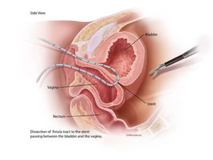 Identifying the vesicovaginal fistula tract during laparoscopic VVF repair