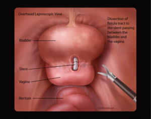 Laparoscopic view identifying the vesicovaginal fistula tract between the bladder and vagina