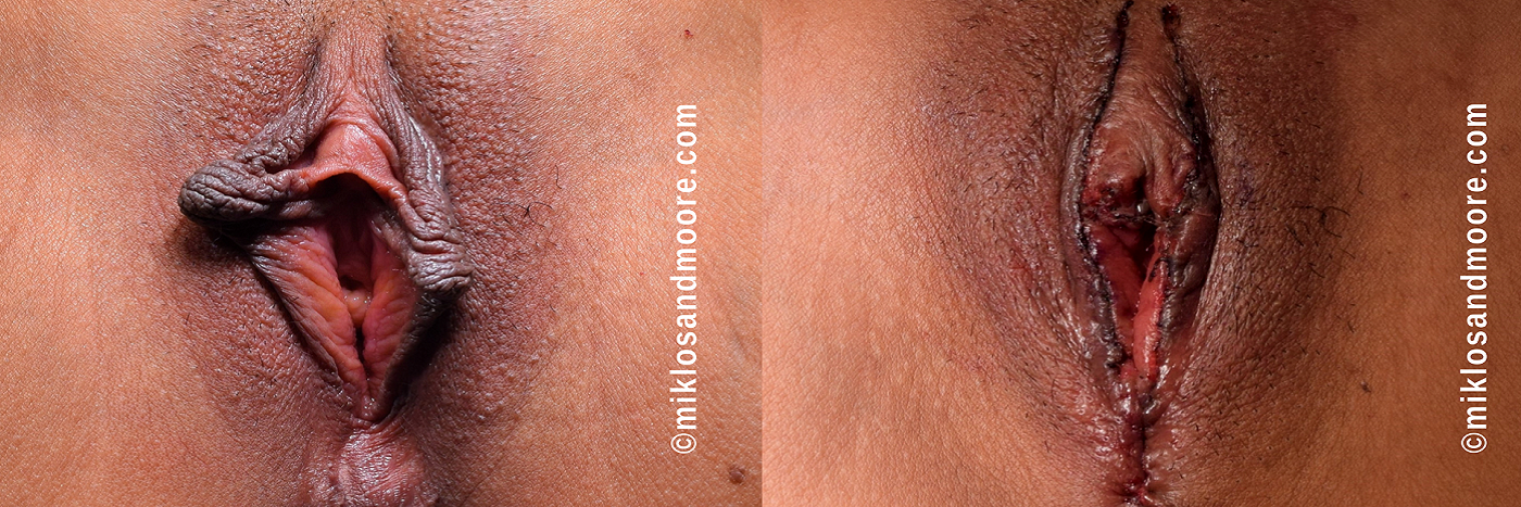 Labiaplasty Surgical Gallery | Drs. Miklos & Moore Labiaplasty before and after photos by Drs. Miklos and Moore demonstrating surgical correction of elongated labial tissue.